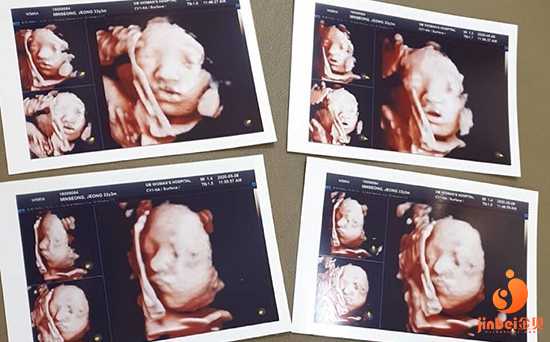 天津代孕网站是真的吗,试管婴儿生出来的双胞胎长得一样吗-上海供卵试管中心